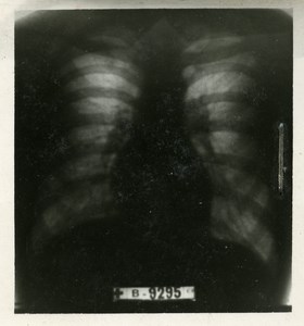 Science Radiological Examination of the Lung France Old Radio Photography 1948