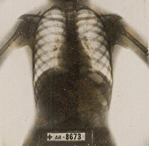 Thoracic Image Rayon X France Old Photo 1947