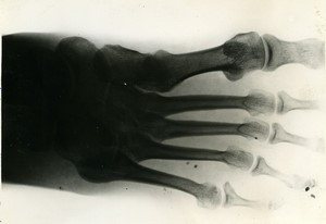 France x-ray radiography of a foot Medical Old Photo 1954